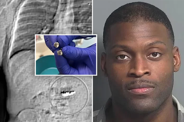 پولیس نے چور کے پیٹ سے ہیرے کی بالیاں برآمد کر لیں