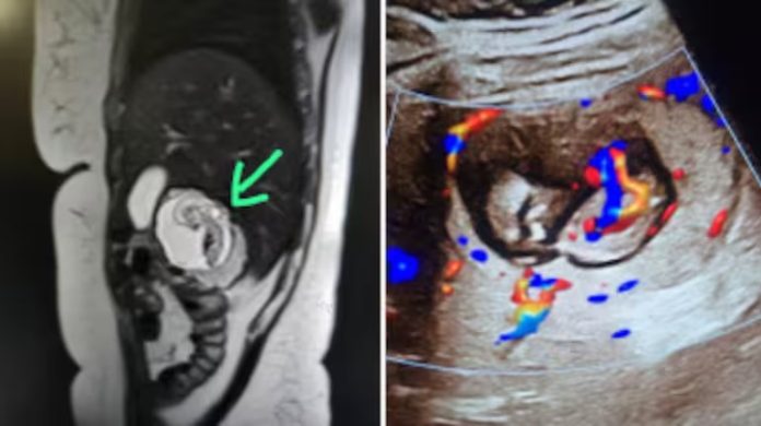 انڈیا میں 35 سالہ خاتون کے جگر میں تین ماہ کا حمل  نایاب طبی معمہ