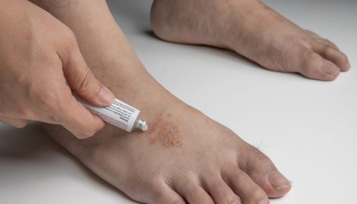 پاکستان نے فنگل انفیکشن کی پہلی مقامی دوا ایجاد کر لی